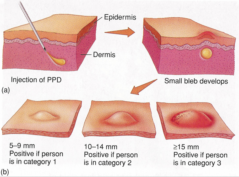 tuberculosis-test-ppd-skin-test-blood-test-how-it-work